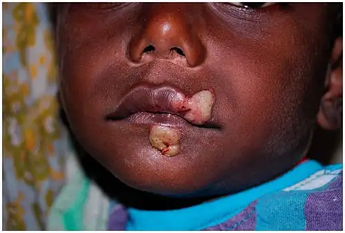 Papilloma mother yaw