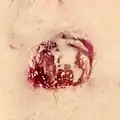 Untreated wound healing