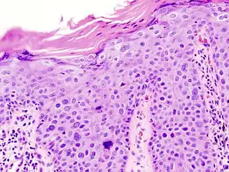cSCC in situ