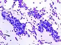 Fibroadenoma, fine needle aspiration biopsy (Giemsa or DiffQuick stain). The image shows abundant bare bipolar stromal nuclei surrounding sheets of metachromatic epithelial cells.