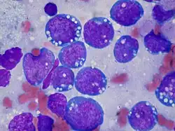 Lymphoma