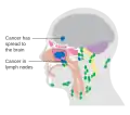 Maxillary sinus cancer that has spread to the brain