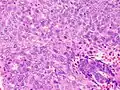 Grade 3: >50% solid non-glandular, non-squamous growth.[62]