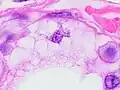 Lipid-laden histiocytes may mimic lipoblasts, but have lightly eosinophilic cytoplasm and a small normochromatic nuclei which are not hollowed out from the lipid vacuoles.[6]