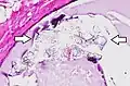 Histopathology of calcium oxalate crystals in a benign breast cyst, H&E stain.