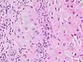 Histopathology of a metastatic melanoma to a lymph node, H&E stain, showing poorly differentiated cells