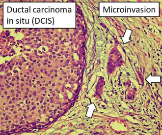 DCIS with microinvasion, defined as focus of invasive cancer measuring up to 1.0&nbsp;mm in size.[26]
