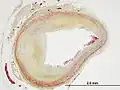 Movat's stain showing luminal stenosis in coronary artery atherosclerosis