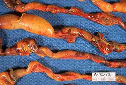 Close-up of intestine showing extensive necrosis (autopsy specimen)