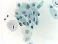 Atrophic squamous cells in postmenopausal women