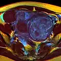 MRI image with multiple uterine leiomyomas