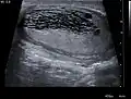 Tubular ectasia of the rete testis
